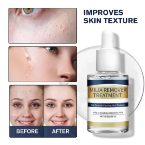 Milia Remover Essence Treatment Fat Granule Clearing Skin Hyaluronic Acid Deep Hydration and Gentle Exfoliation Hydrates Smooths